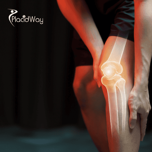 Arthroscopic Knee Surgery in Turkey: Affordable and Advanced Solutions for Australian Tourists